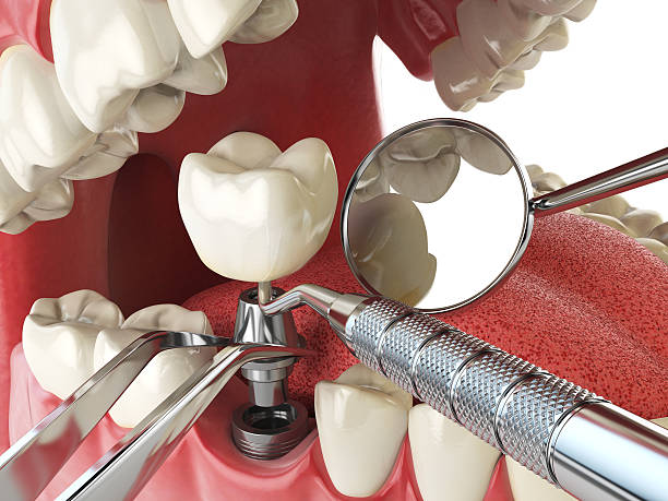 Best Emergency Dental Care for Broken or Chipped Teeth in Avilla, IN